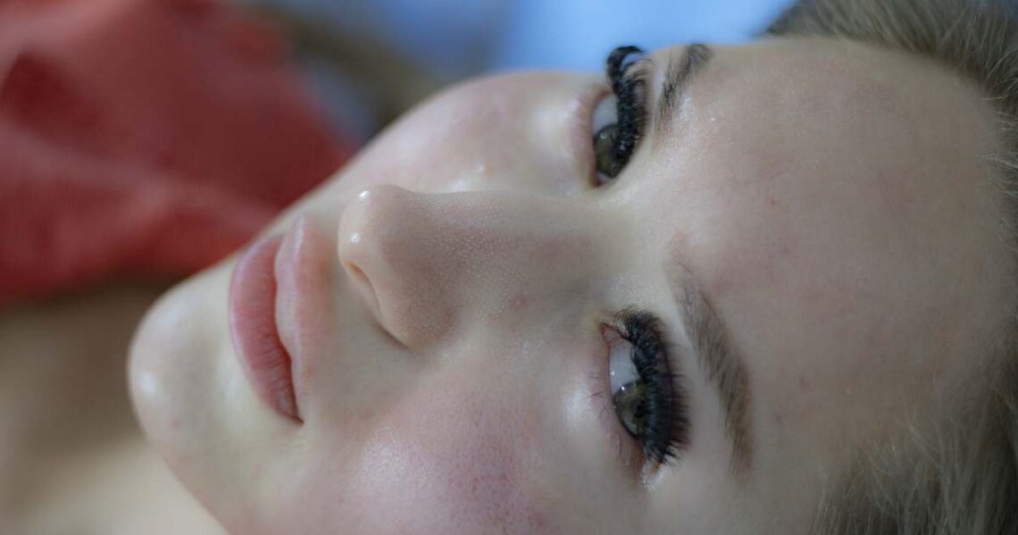 donna con acne in viso